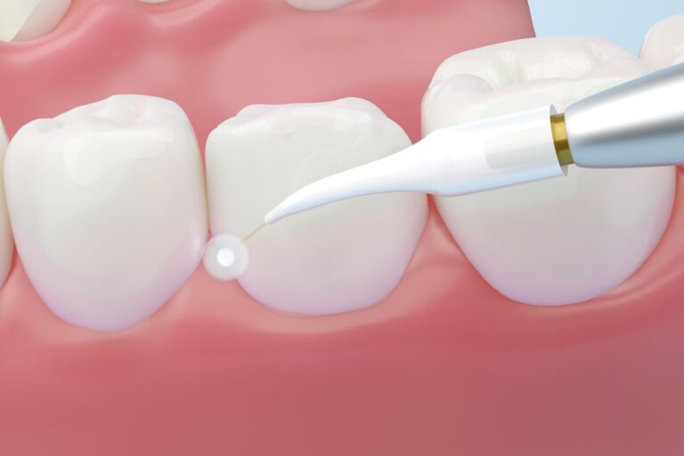 close-up illustration of a dental procedure showing a laser dental tool